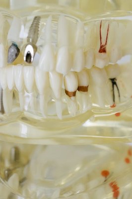 ¿Cuánto tiempo dura el proceso de colocación de un implante dental?